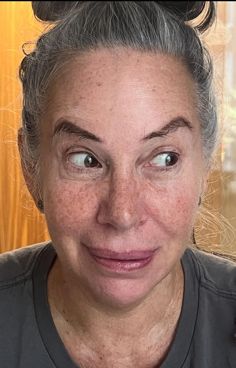 After Image: Botox for forehead - front