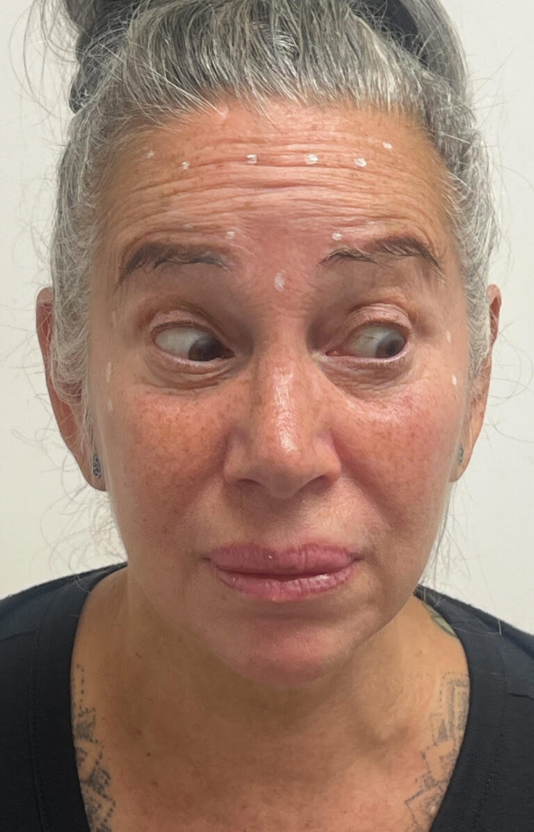 Before Image: Botox for forehead - front