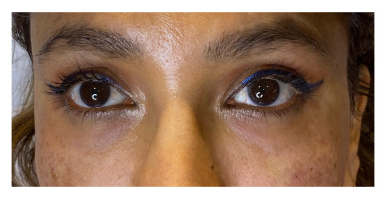 After Image: Tear Trough - front