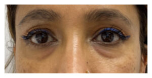 Before Image: Tear Trough