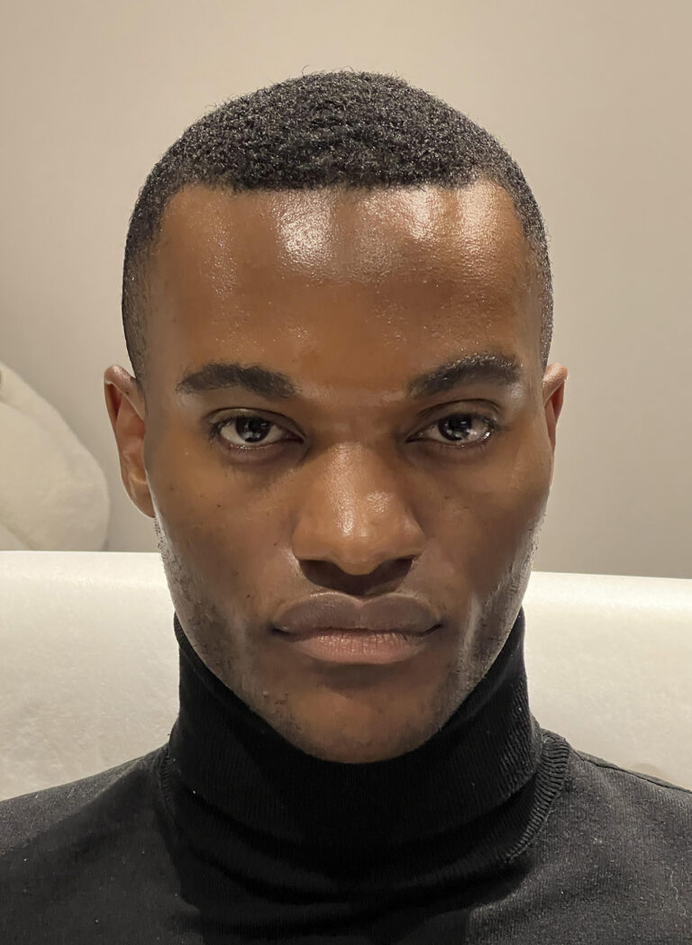 After Image: Cheek Filler - front