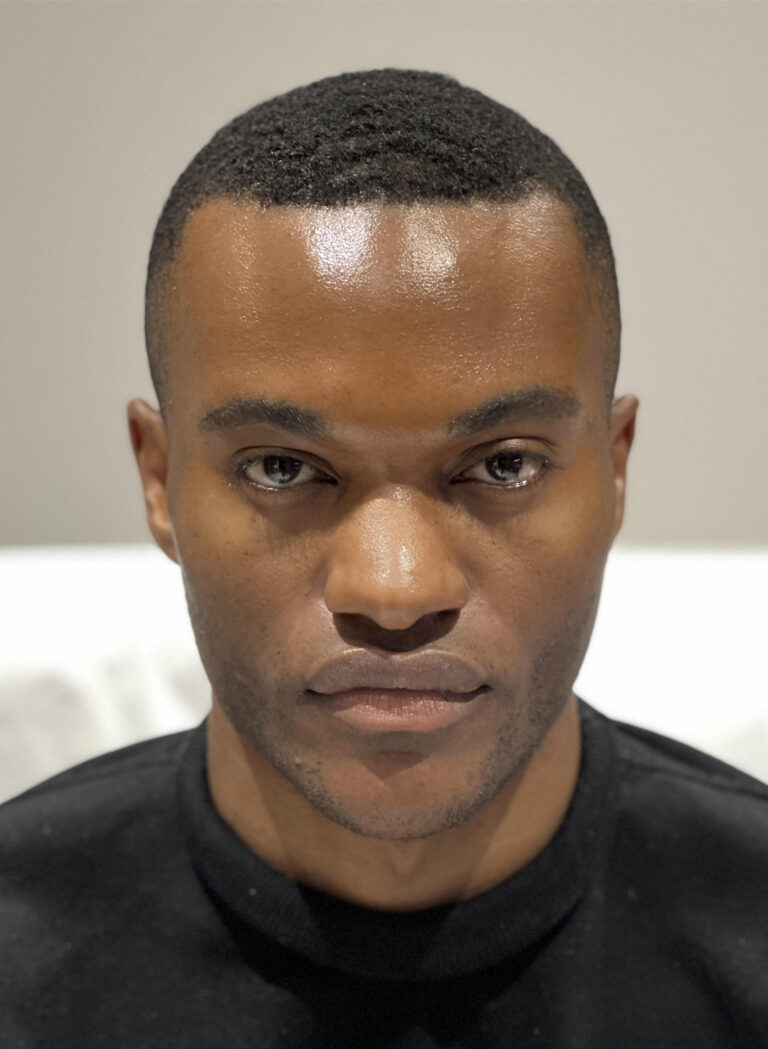 Before Image: Cheek Filler - front