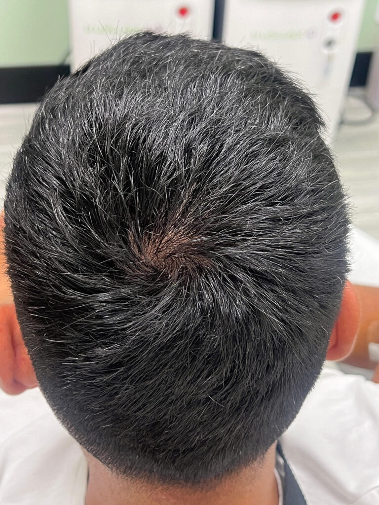 Before Image: Hair restoration with PRP - back