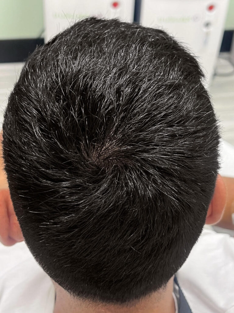 After Image: Hair restoration with PRP - back