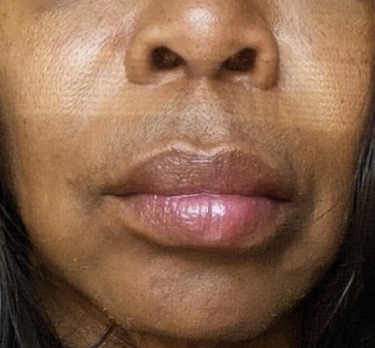 After Image: Lip Filler - front