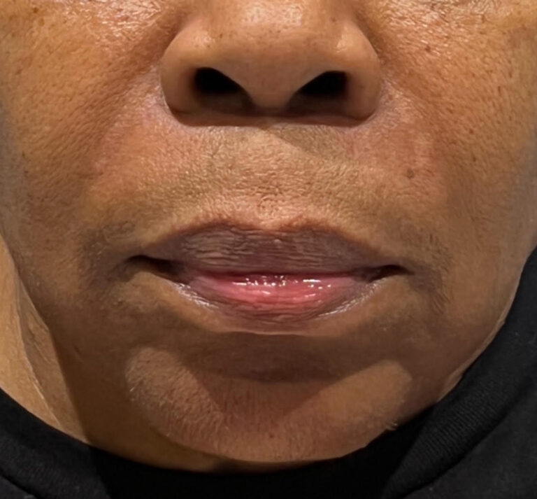 Before Image: Lip Filler - front
