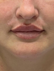 After Image: Lip Filler