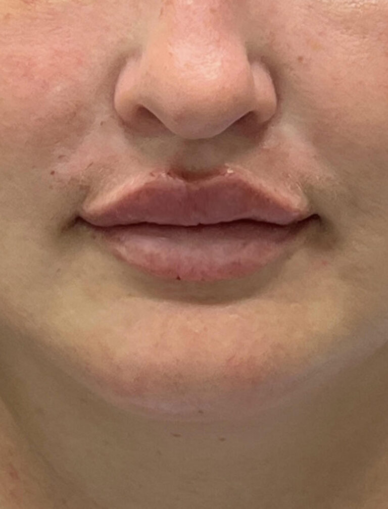 After Image: Lip Filler - front
