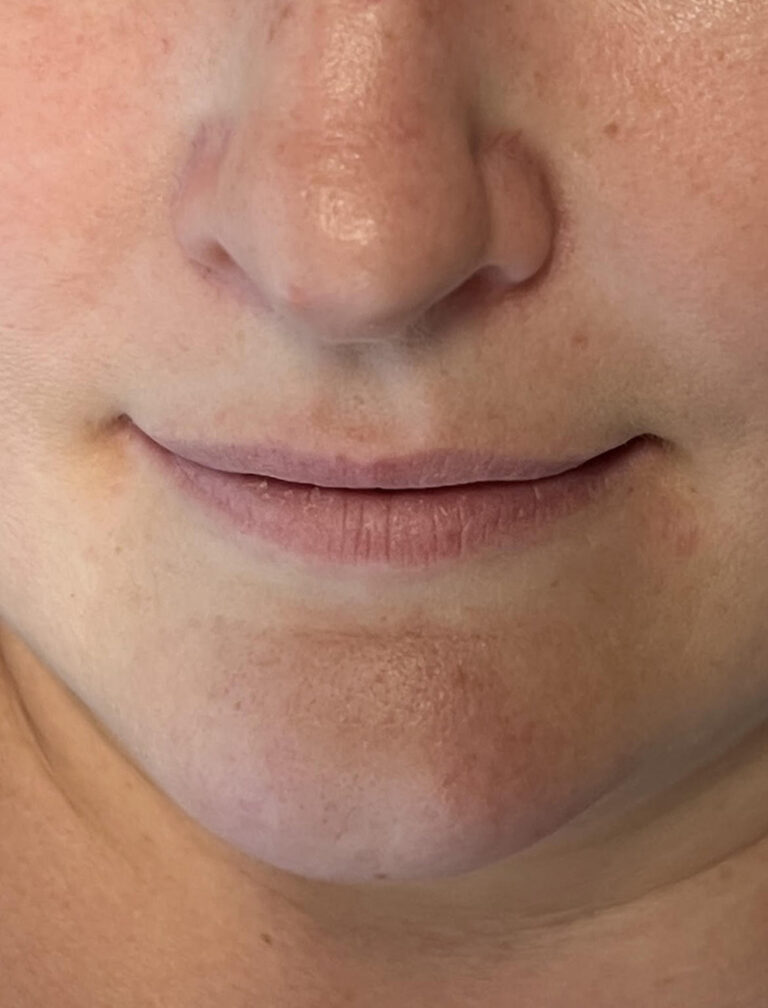 Before Image: Lip Filler - front