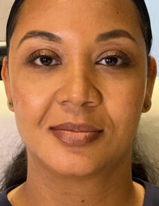 After Image: Tear trough (under eye) filler