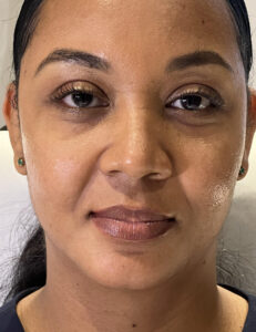 Before Image: Tear trough (under eye) filler
