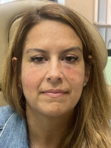 After Image: Tear trough (under eye) filler