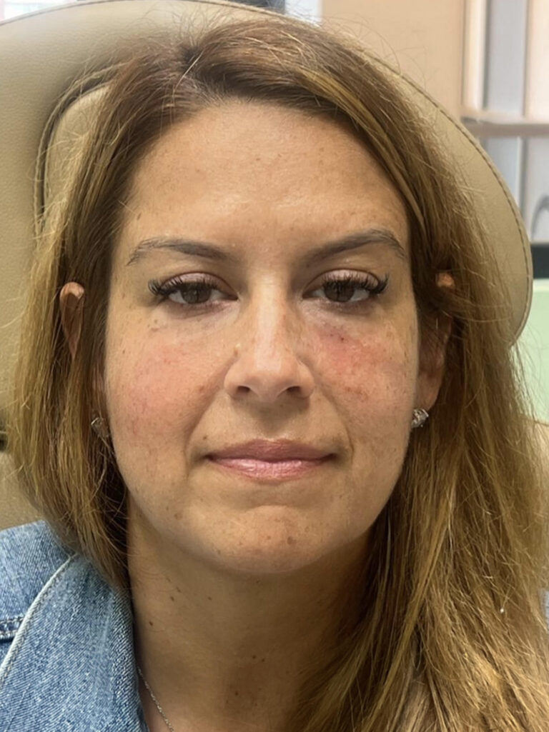 After Image: Tear trough (under eye) filler - front