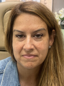 Before Image: Tear trough (under eye) filler