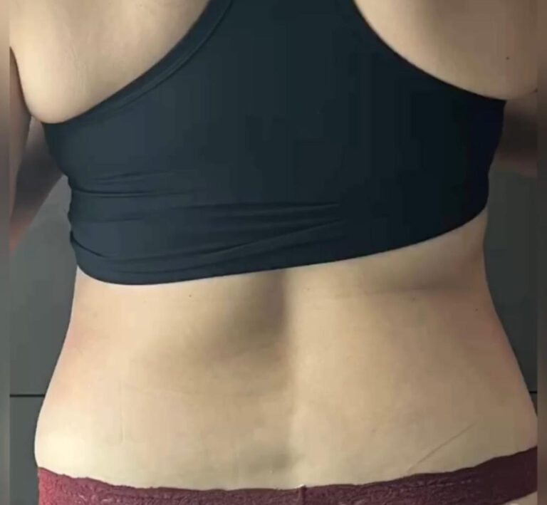 After Image: TruSculpt - back