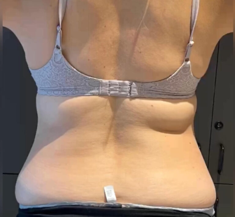 Before Image: TruSculpt - back