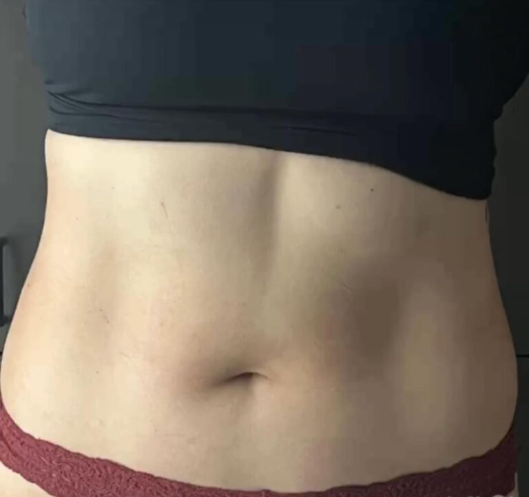 After Image: TruSculpt - front