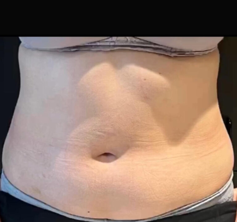 Before Image: TruSculpt - front
