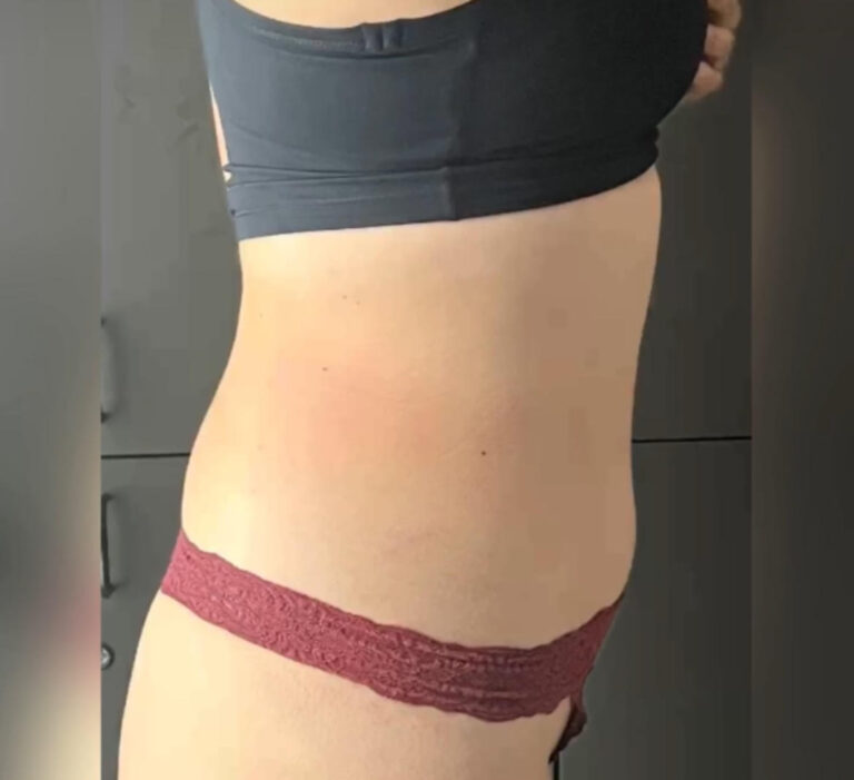 After Image: TruSculpt - right-side