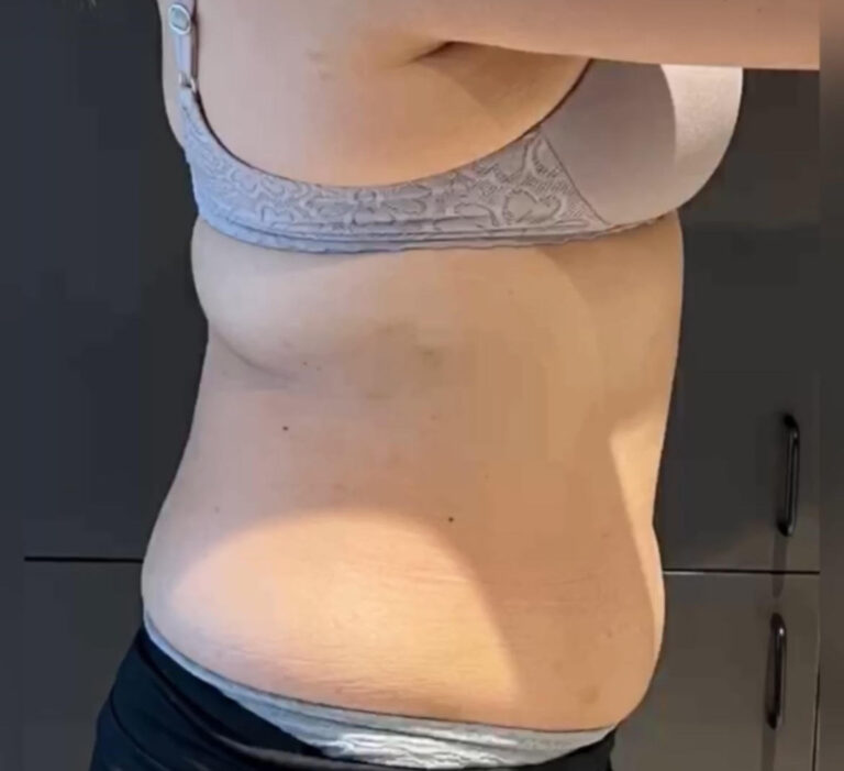 Before Image: TruSculpt - right-side